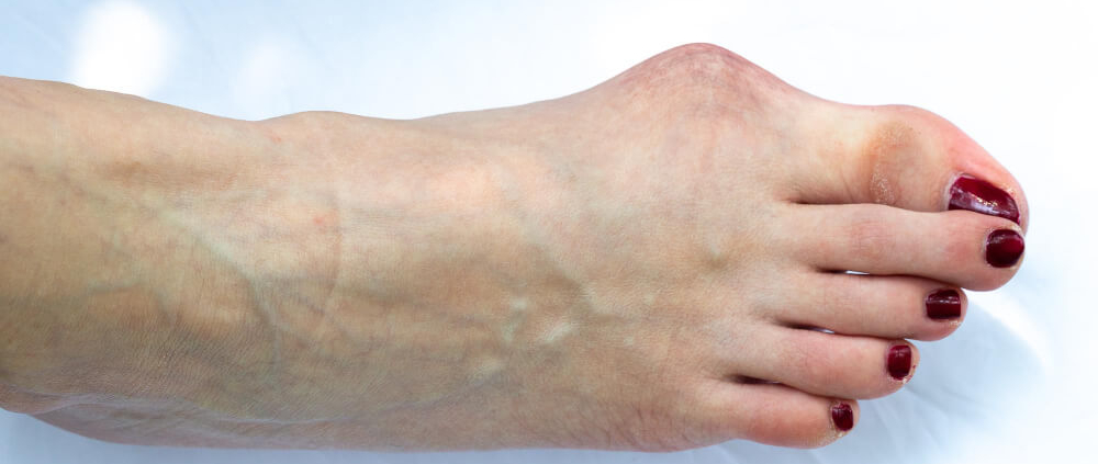 juanetes tratamientos