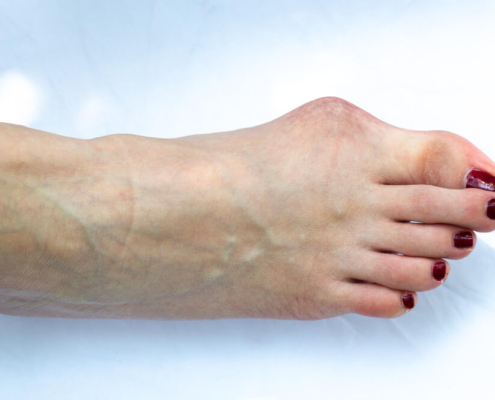 juanetes tratamientos